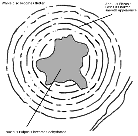 diagram of a degenerative disc showing the irregular changes to the centre of the disc