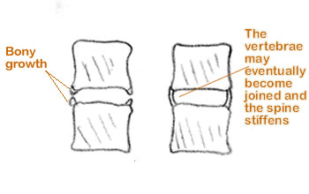 ankylosing spondylitis