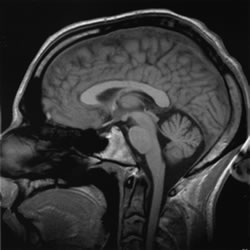 Brain MRI