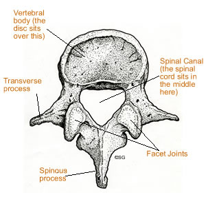 spinal stenosis